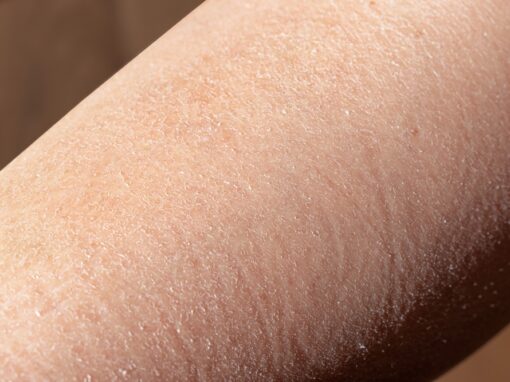 Piel agrietada: Qué es, causas y tratamiento